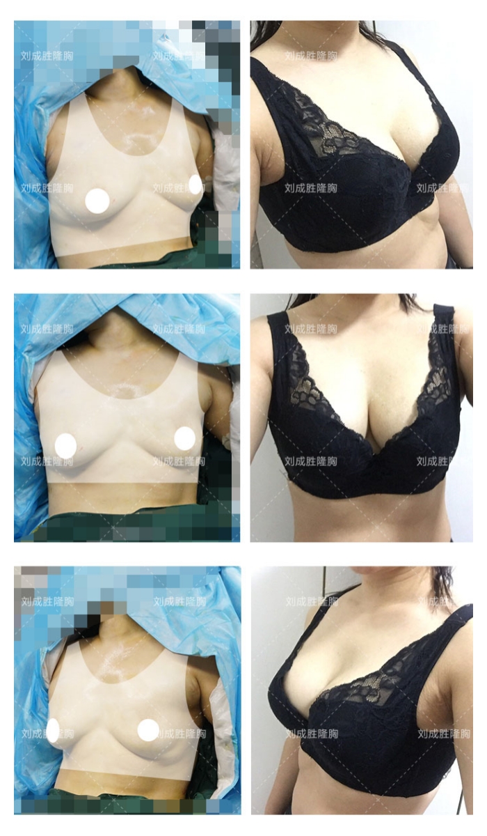 丰体针丰胸可能引发的身体不适，早预防早治疗